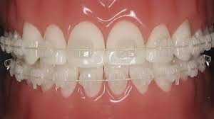 Ceramic braces - Braces in Ottawa