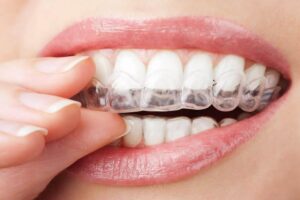 Invisalign braces - Braces in Ottawa