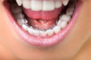 Lingual braces - Braces in Ottawa