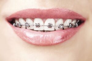 Metal braces - Braces in Ottawa